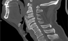 cervical spine